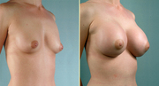 1.Enlarge or reduce your breasts...+27784057265