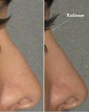 NoseJob, Rhinoplasty and Facelift in Dublin-The Clinic Sandymount Green