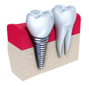 Find Dental Implants Surgeons in Dublin 7